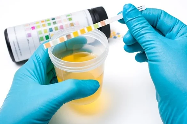 Urine Analysis